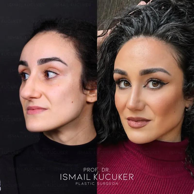 Before and after — Dr. İsmail Küçüker