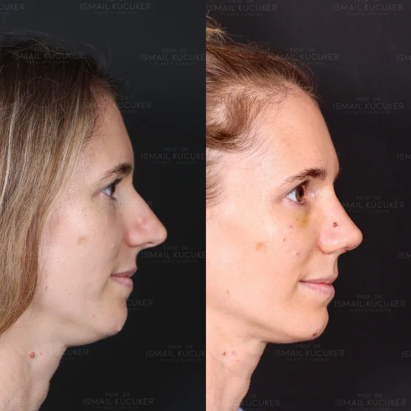 Before and after — Dr. İsmail Küçüker