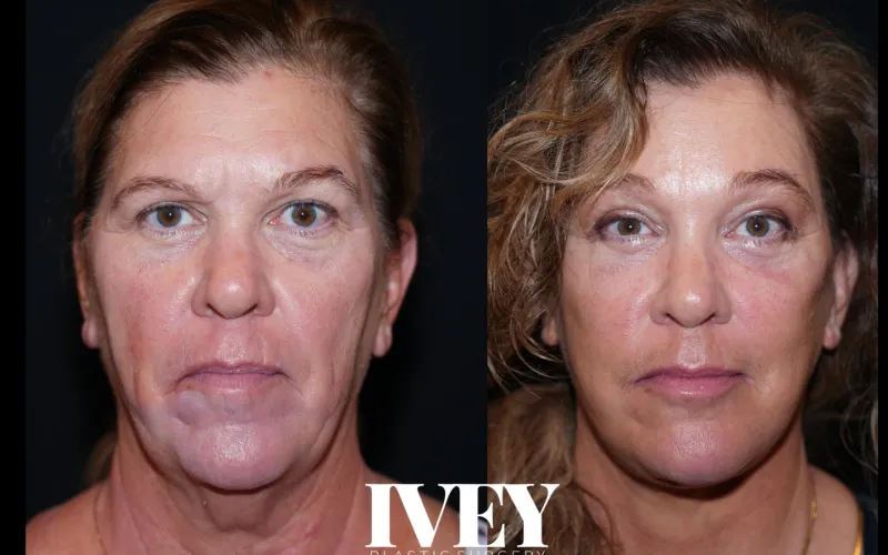 Before and after: Dr. J. Simon Ivey