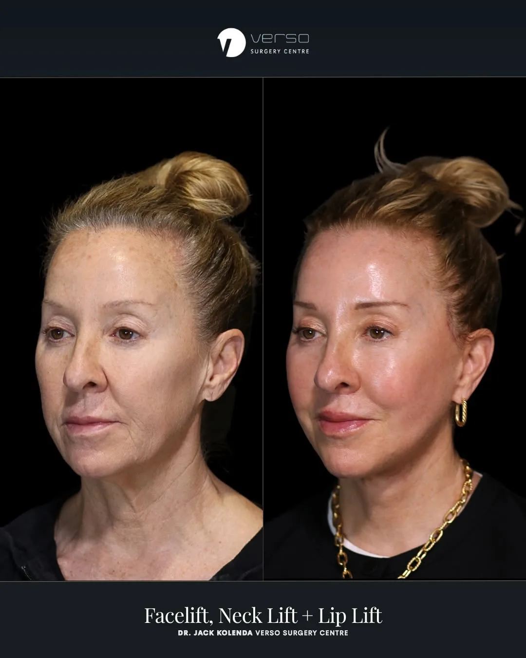 Before and after — Dr. Jack Kolenda