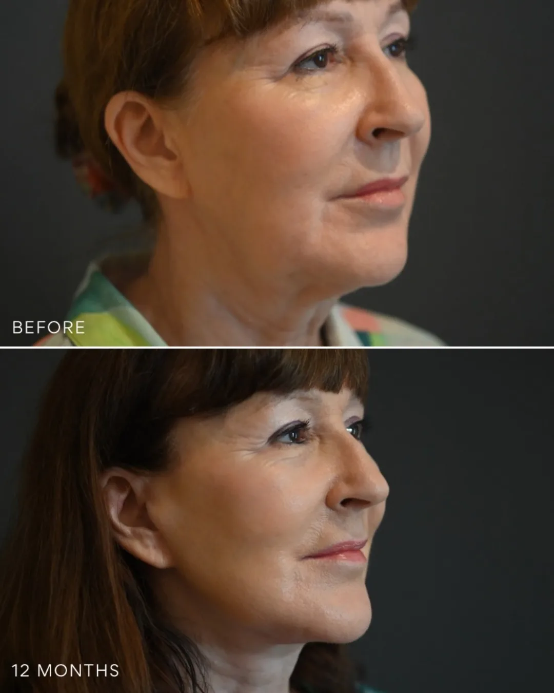 Before and after deep plane facelift — 55-year-old woman, right profile view, 12mo post-op by Dr. Jack Zoumaras