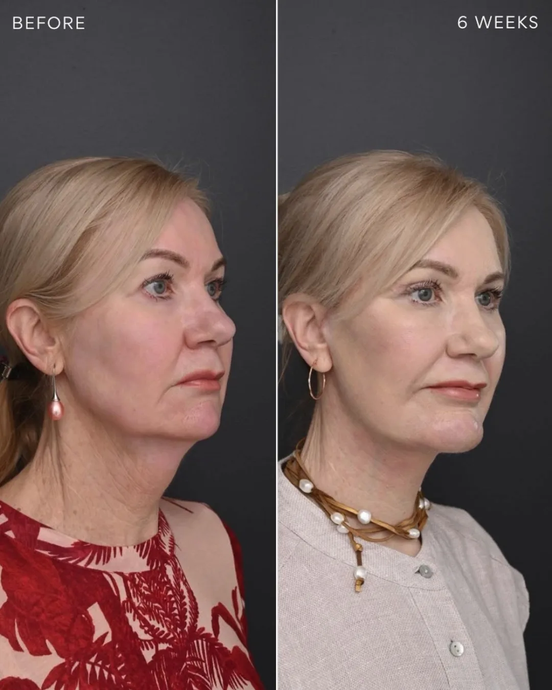 Before and after deep plane facelift — 52-year-old woman, left profile view, 6mo post-op by Dr. Jack Zoumaras