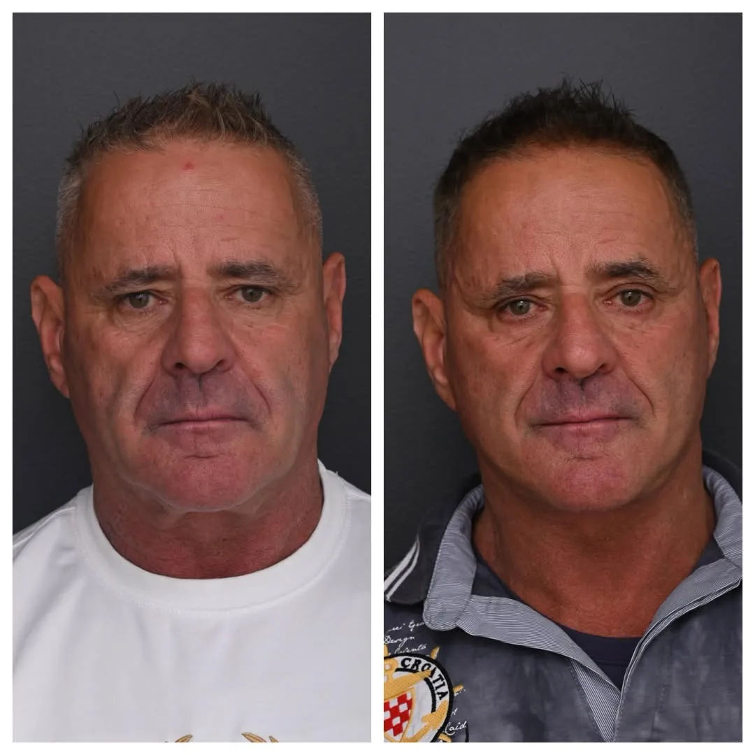 Before and after deep plane facelift — 55-year-old man, frontal view, 7mo post-op by Dr. Jack Zoumaras