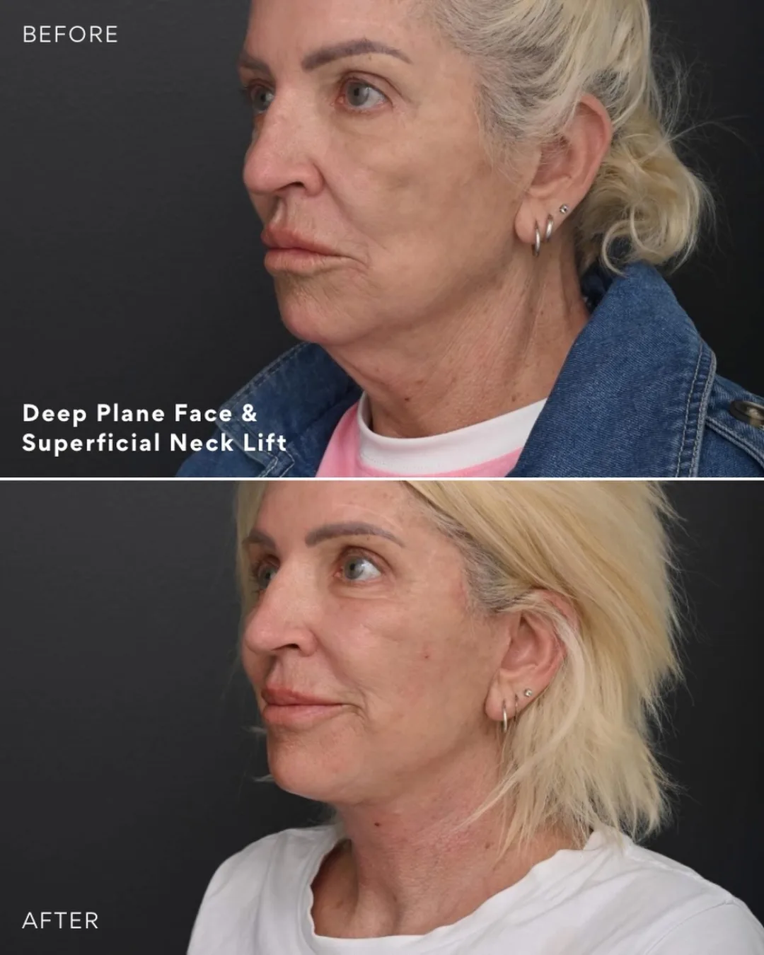 Before and after deep plane facelift — 58-year-old woman, left profile view, 6mo post-op by Dr. Jack Zoumaras