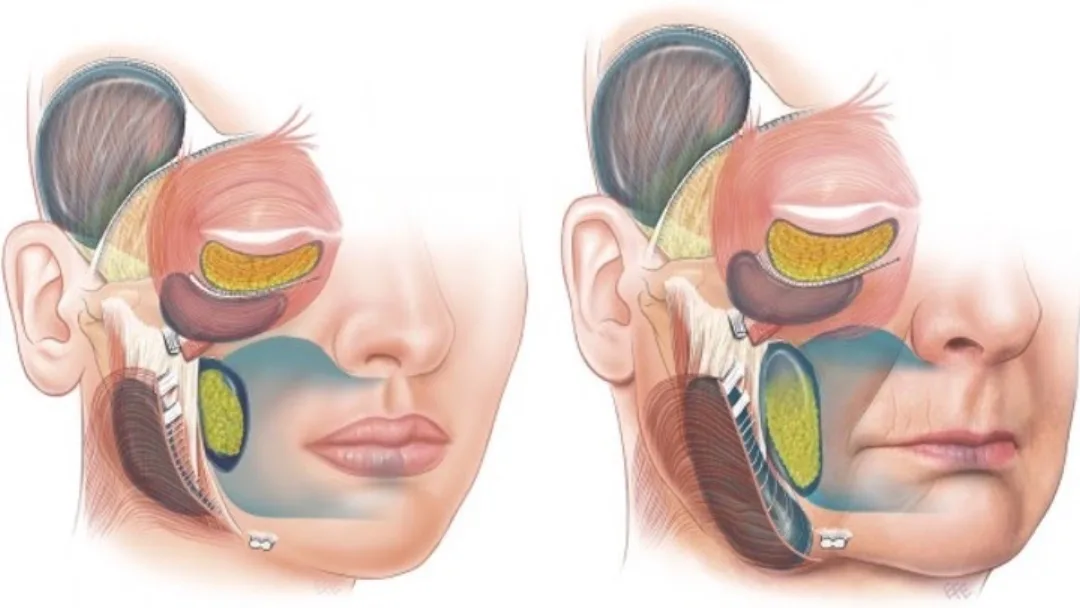 Before and after deep plane facelift — 45-year-old woman, oblique right view by Dr. Jack Zoumaras