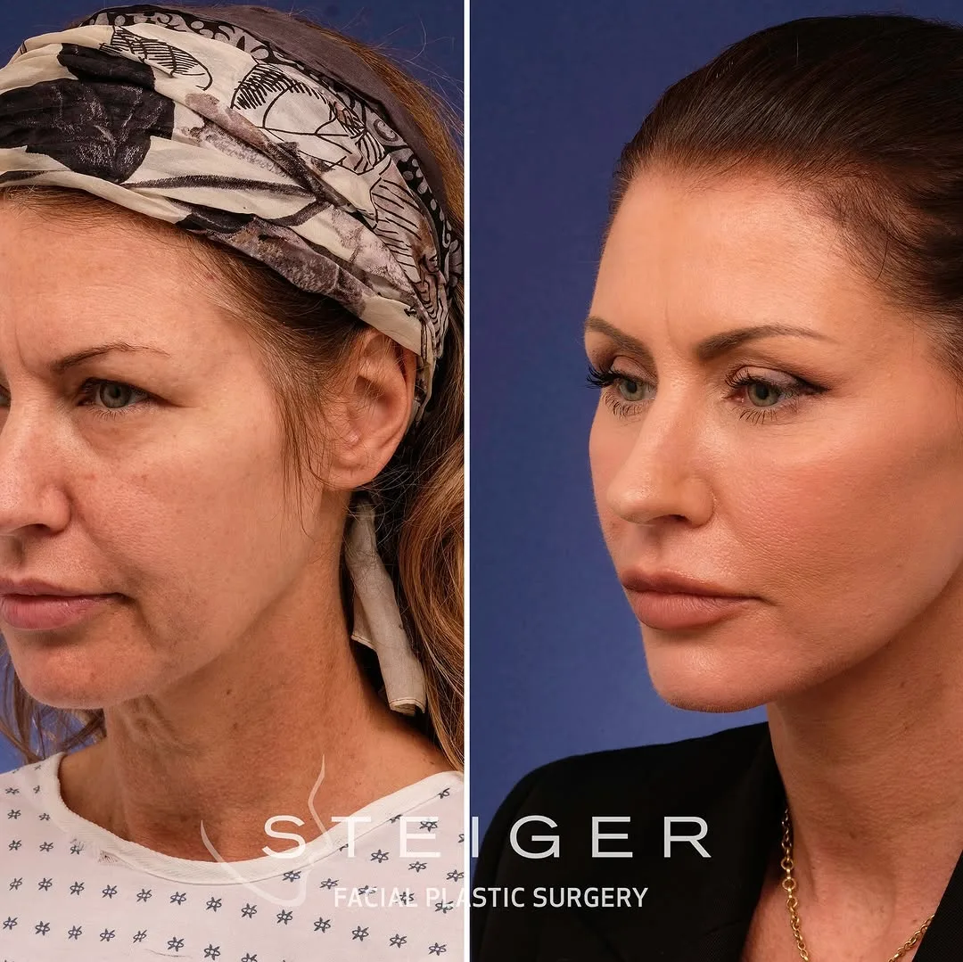 Before and after — Dr. Jacob Steiger