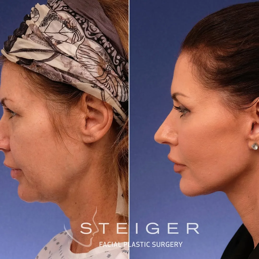 Before and after — Dr. Jacob Steiger
