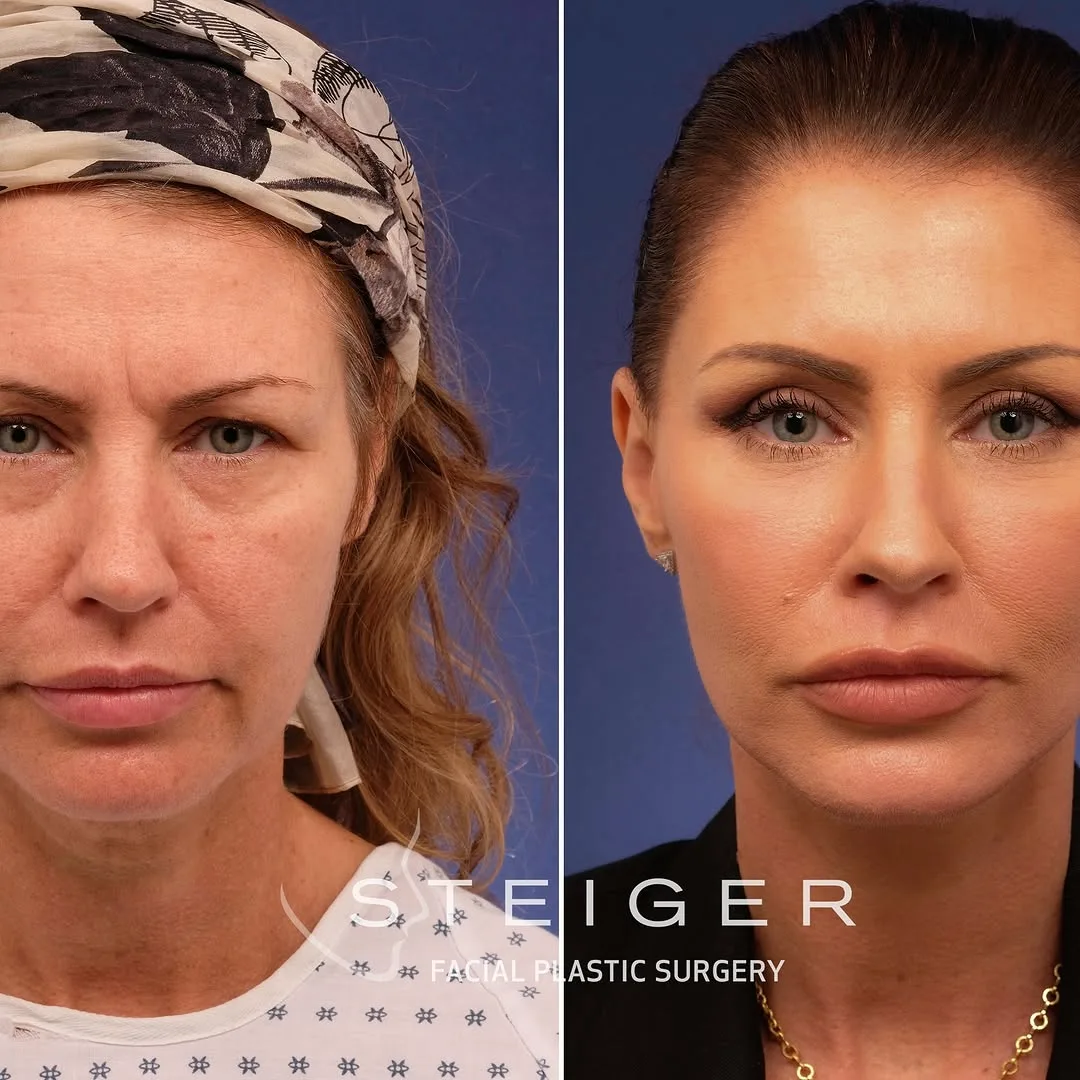 Before and after — Dr. Jacob Steiger