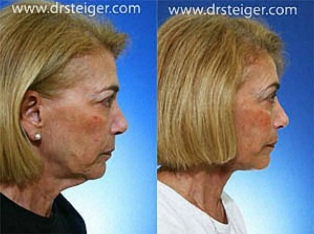 Before and after — Dr. Jacob Steiger