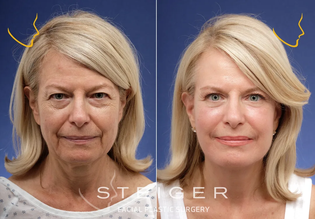 Before and after: Dr. Jacob Steiger