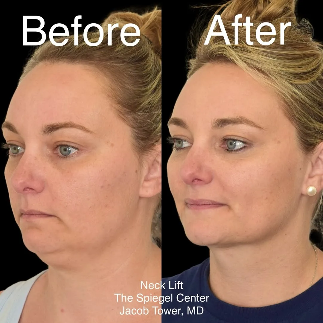 Before and after — Dr. Jacob Tower
