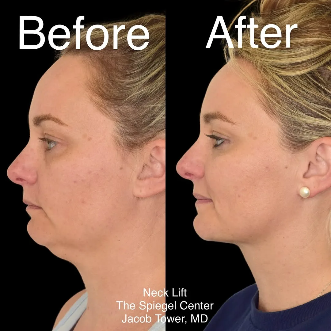 Before and after — Dr. Jacob Tower