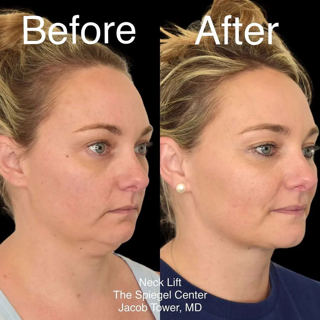 Before and after — Dr. Jacob Tower