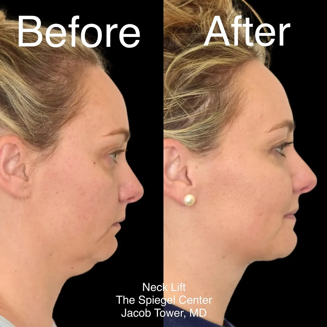 Before and after — Dr. Jacob Tower