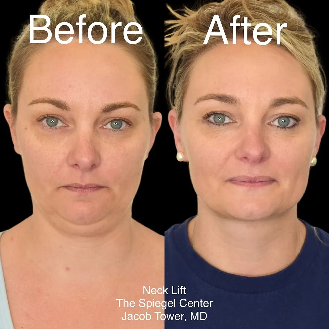 Before and after — Dr. Jacob Tower