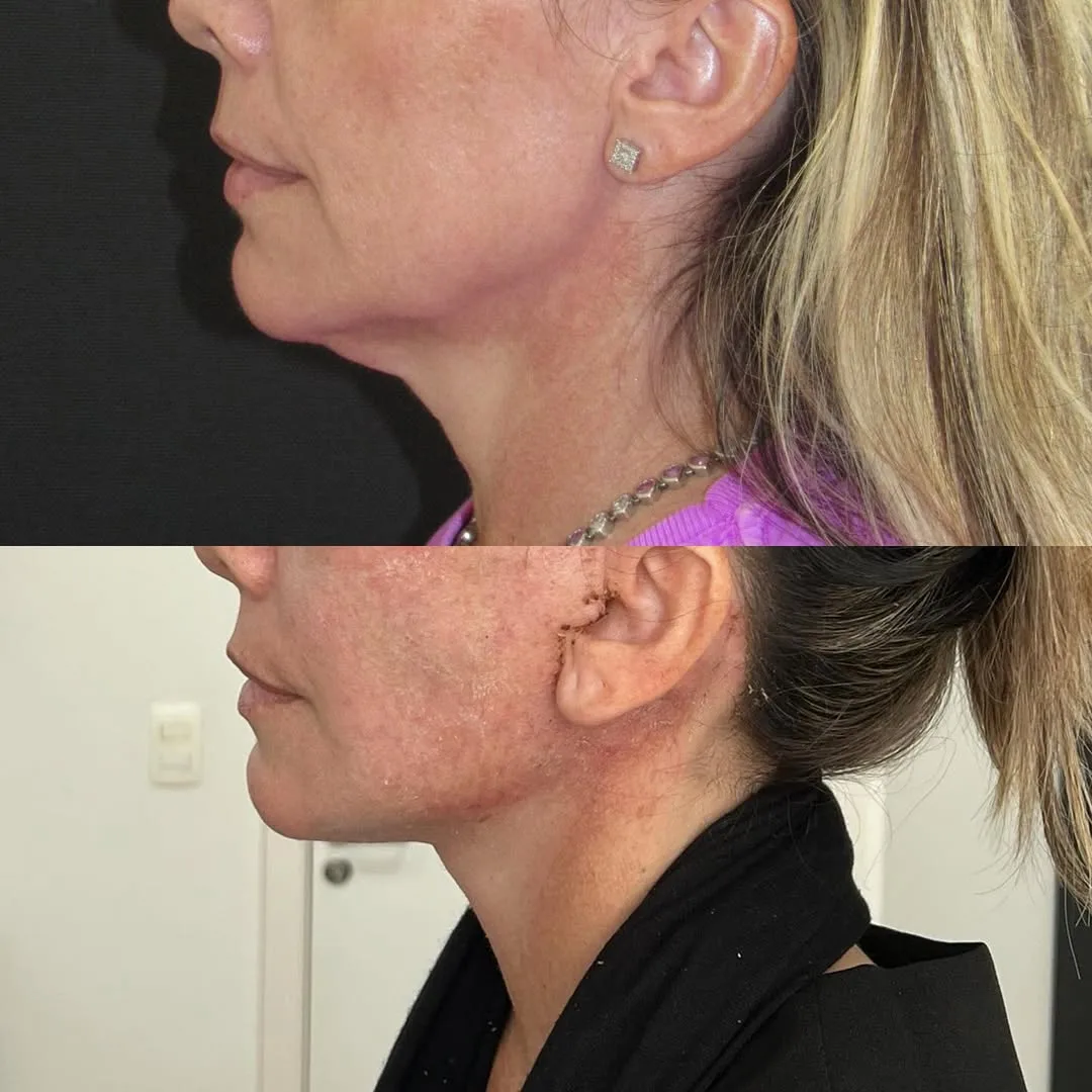 Before and after deep plane facelift — 52-year-old woman, left profile view, 6mo post-op by Dr. Jair Maciel