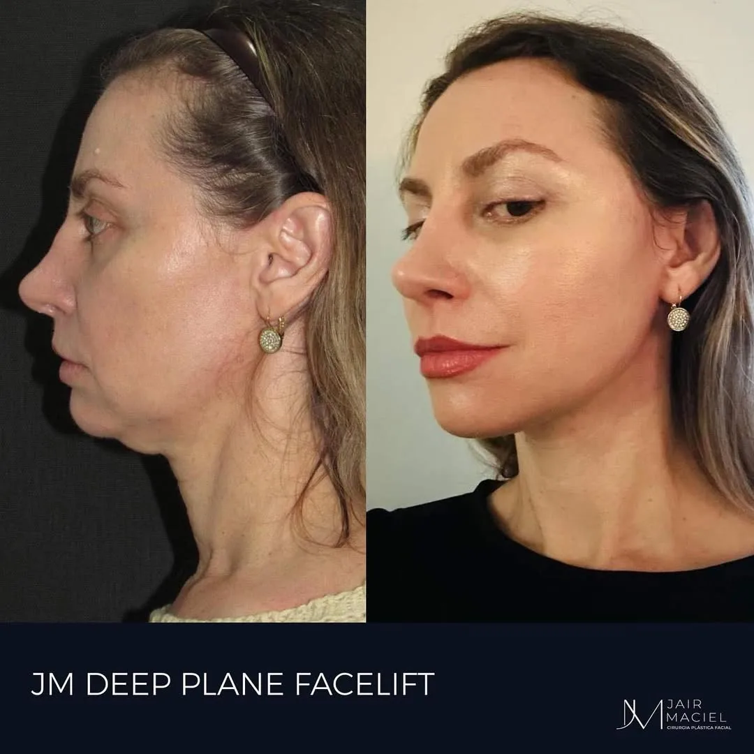 Before and after deep plane facelift — 52-year-old woman, right profile view, 12mo post-op by Dr. Jair Maciel