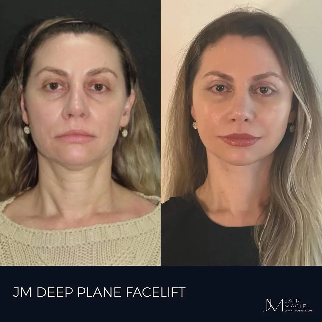 Before and after deep plane facelift — 48-year-old woman, frontal view, 7mo post-op by Dr. Jair Maciel