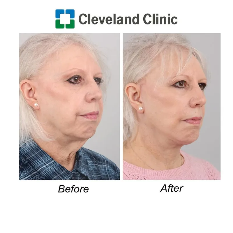 Before and after — Dr. James Zins