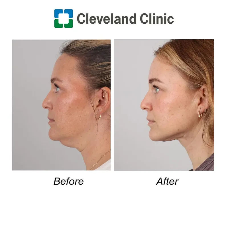 Before and after — Dr. James Zins