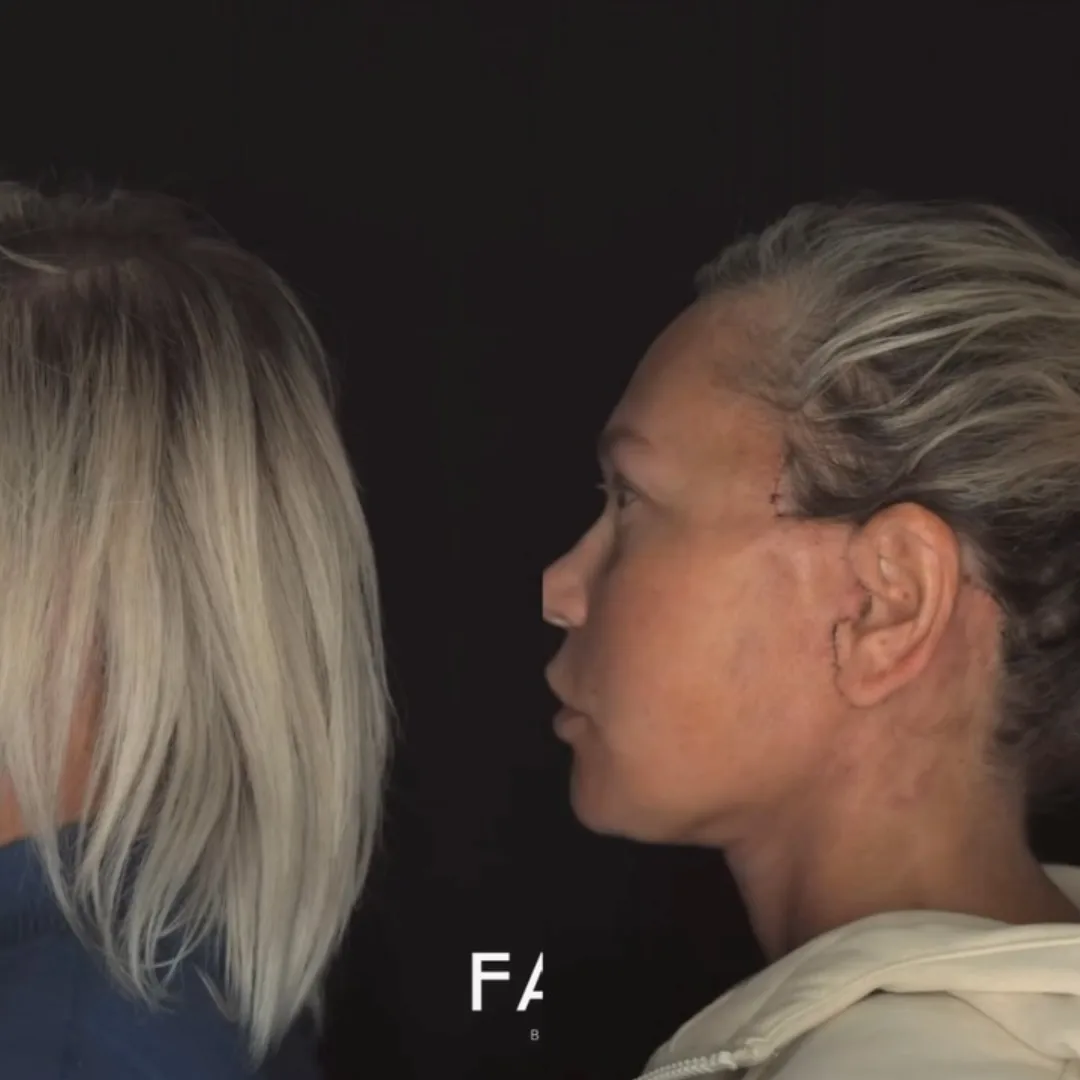 Before and after deep plane facelift — 42-year-old woman, right profile view, 6mo post-op by Dr. Jamil Asaria