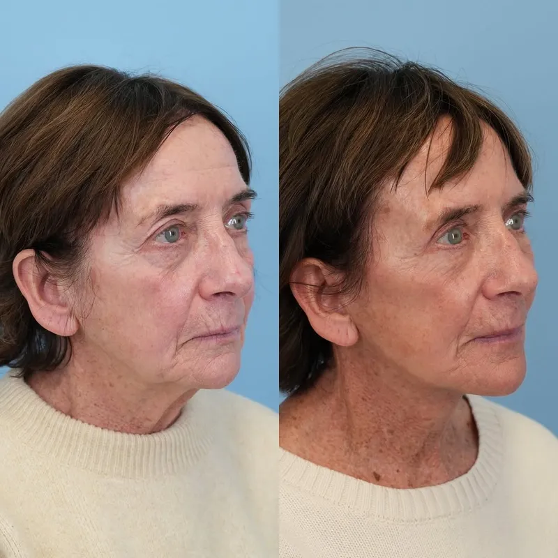 Before and after — Dr. Jason Bloom