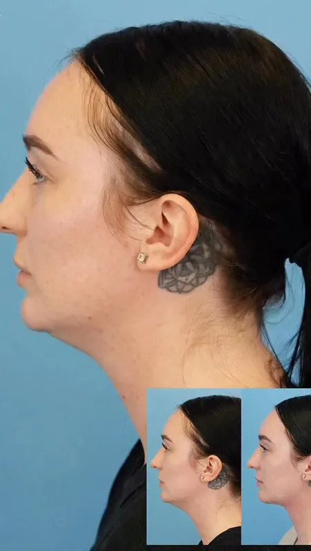 Before and after — Dr. Jason Bloom
