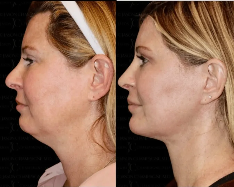 Before and after — Dr. Jason Champagne