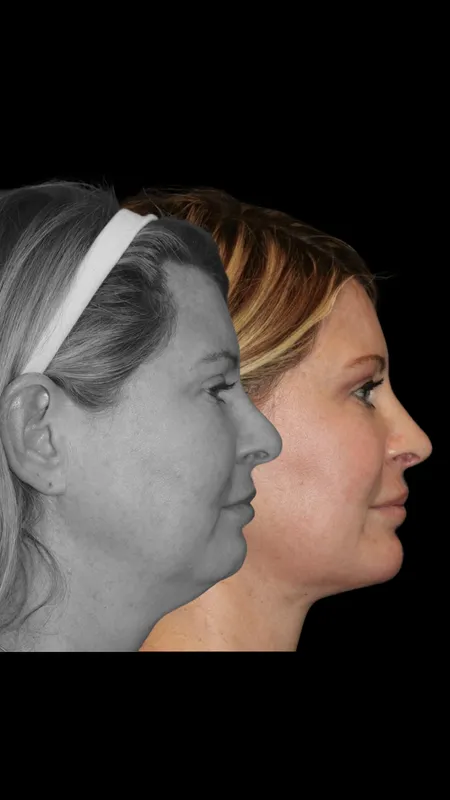 Before and after — Dr. Jason Champagne