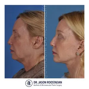 Before and after — Dr. Jason Roostaeian