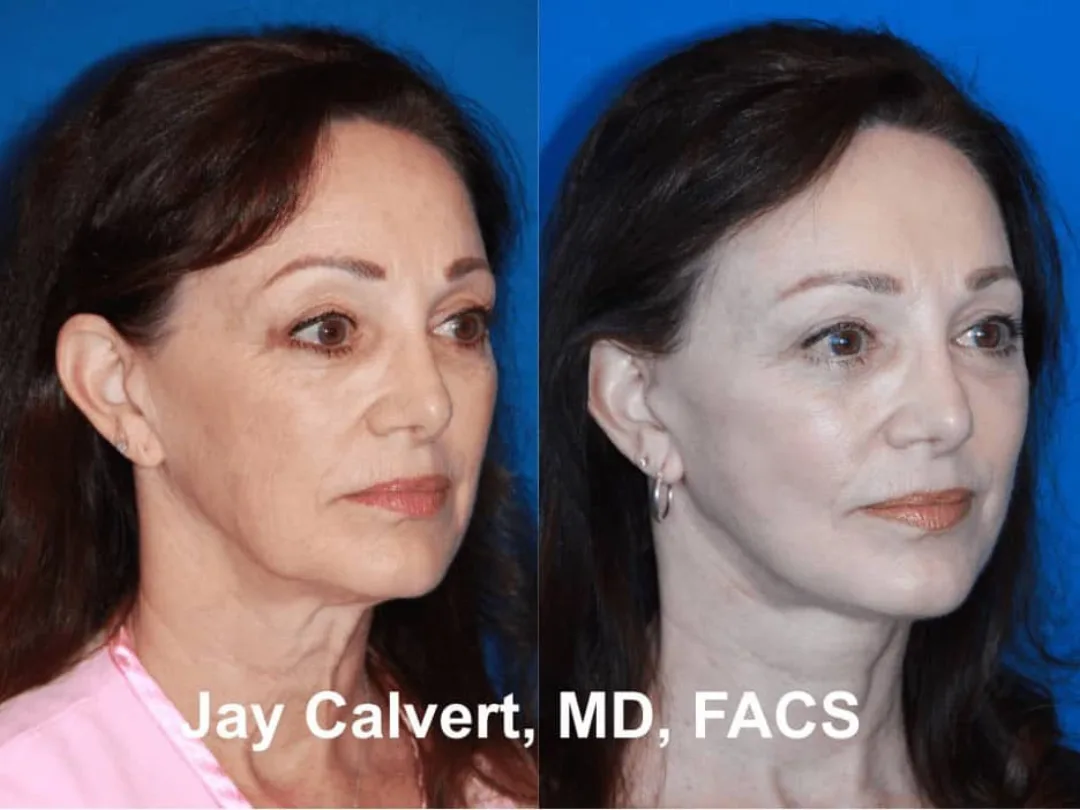 Before and after — Dr. Jay Calvert