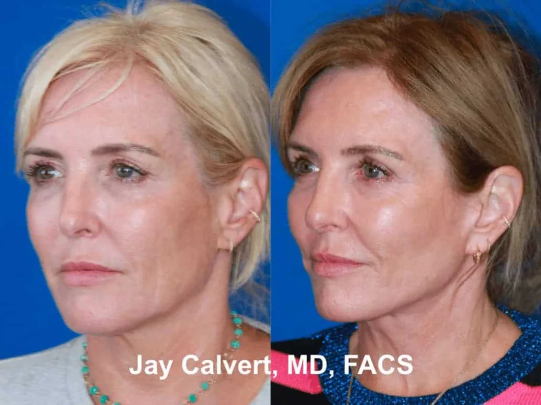 Before and after — Dr. Jay Calvert