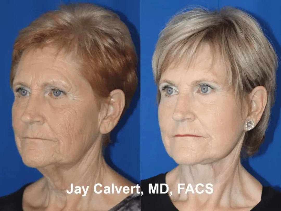Before and after — Dr. Jay Calvert