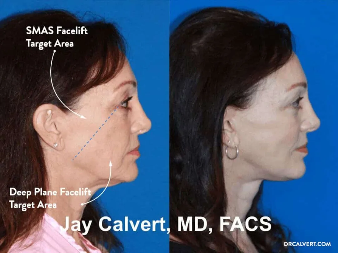 Before and after — Dr. Jay Calvert