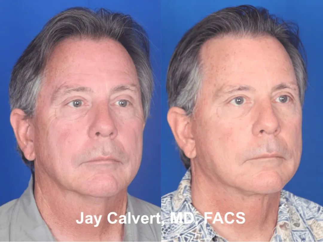 Before and after — Dr. Jay Calvert