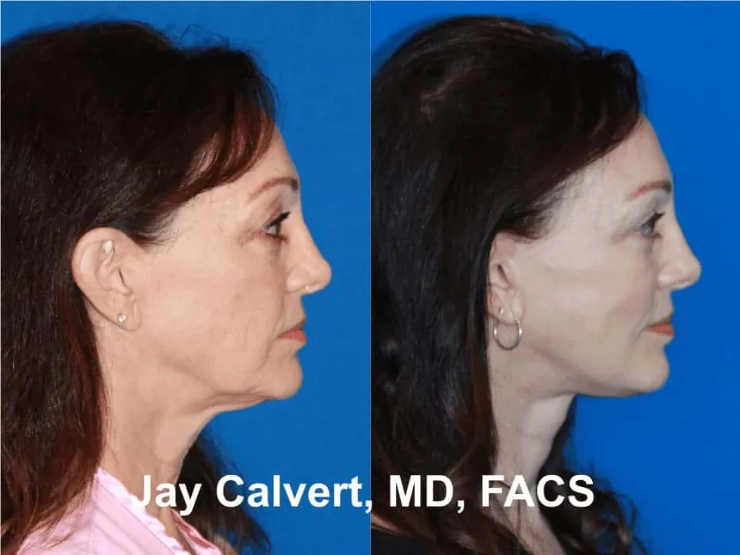 Before and after — Dr. Jay Calvert