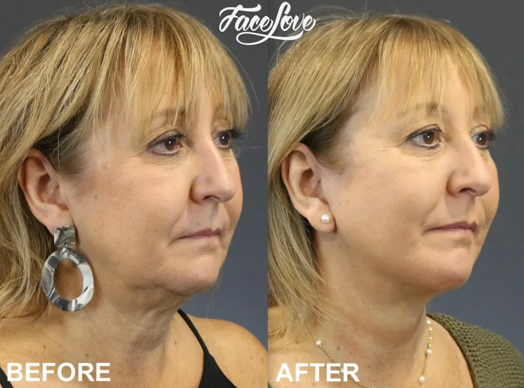 Before and after deep plane facelift — 62-year-old woman, three-quarter view, 6mo post-op by Dr. Jay Keni