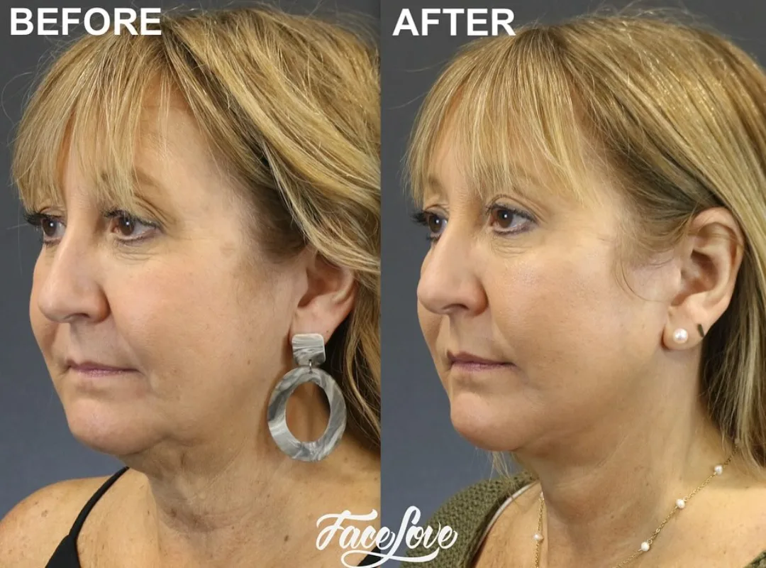 Before and after deep plane facelift — 58-year-old woman, three-quarter view, 6mo post-op by Dr. Jay Keni