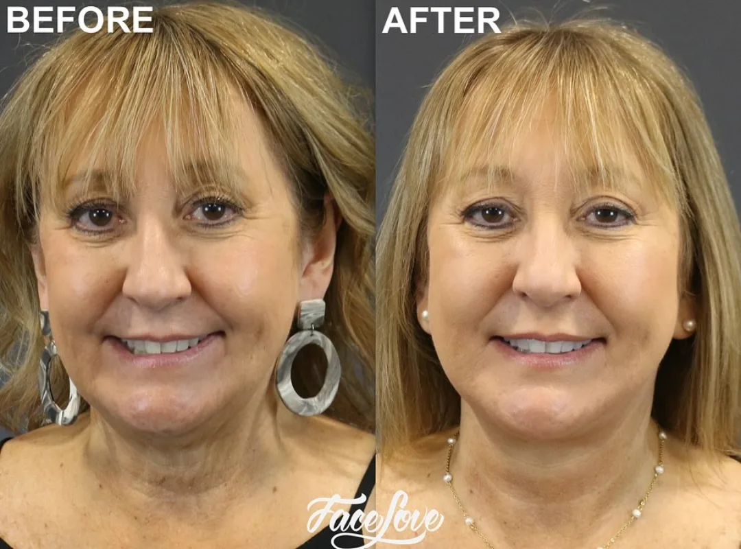 Before and after deep plane facelift — 58-year-old woman, frontal view, 6mo post-op by Dr. Jay Keni