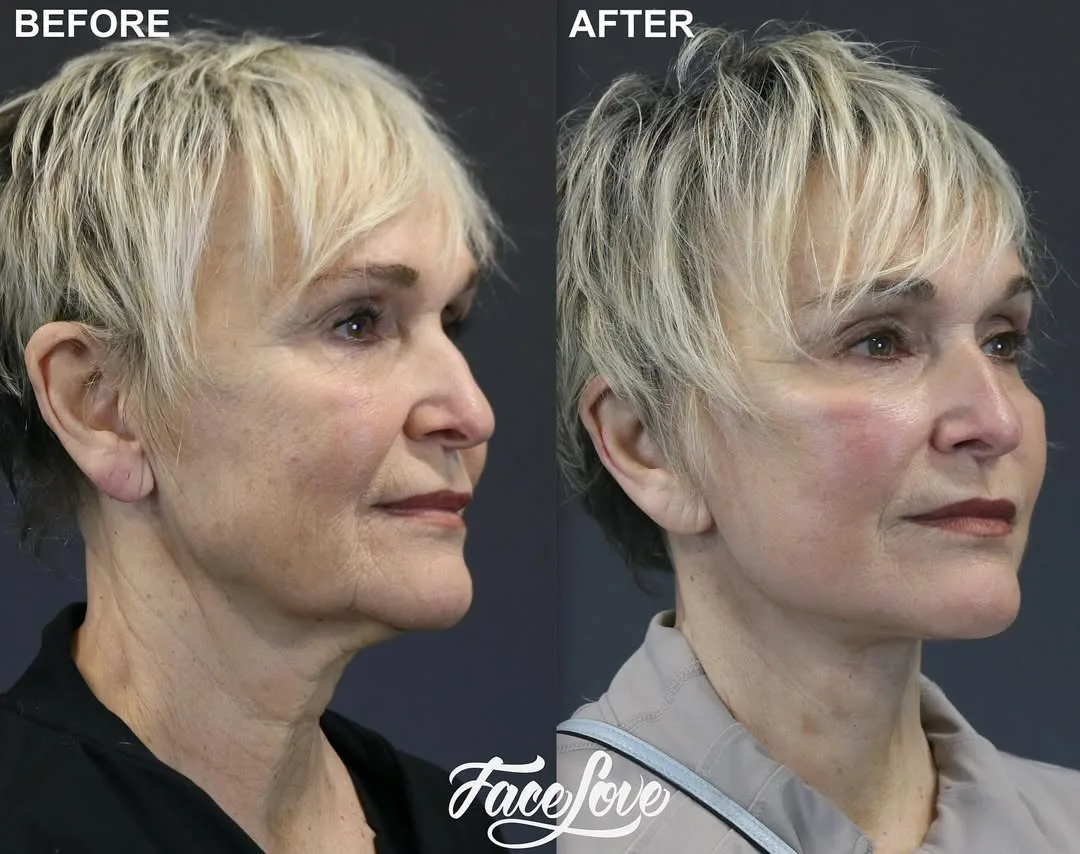 Before and after deep plane facelift — 62-year-old woman, three-quarter view, 1mo post-op by Dr. Jay Keni