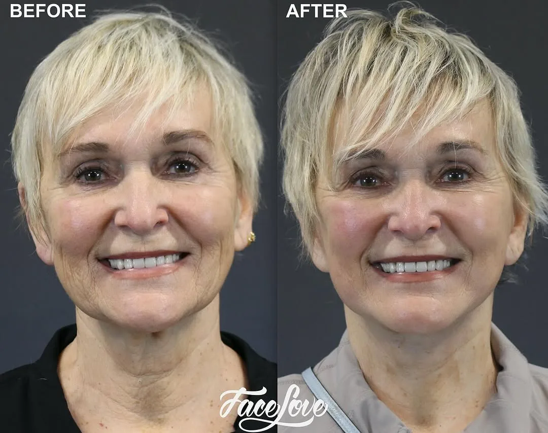 Before and after deep plane facelift — 65-year-old woman, frontal view, 1mo post-op by Dr. Jay Keni