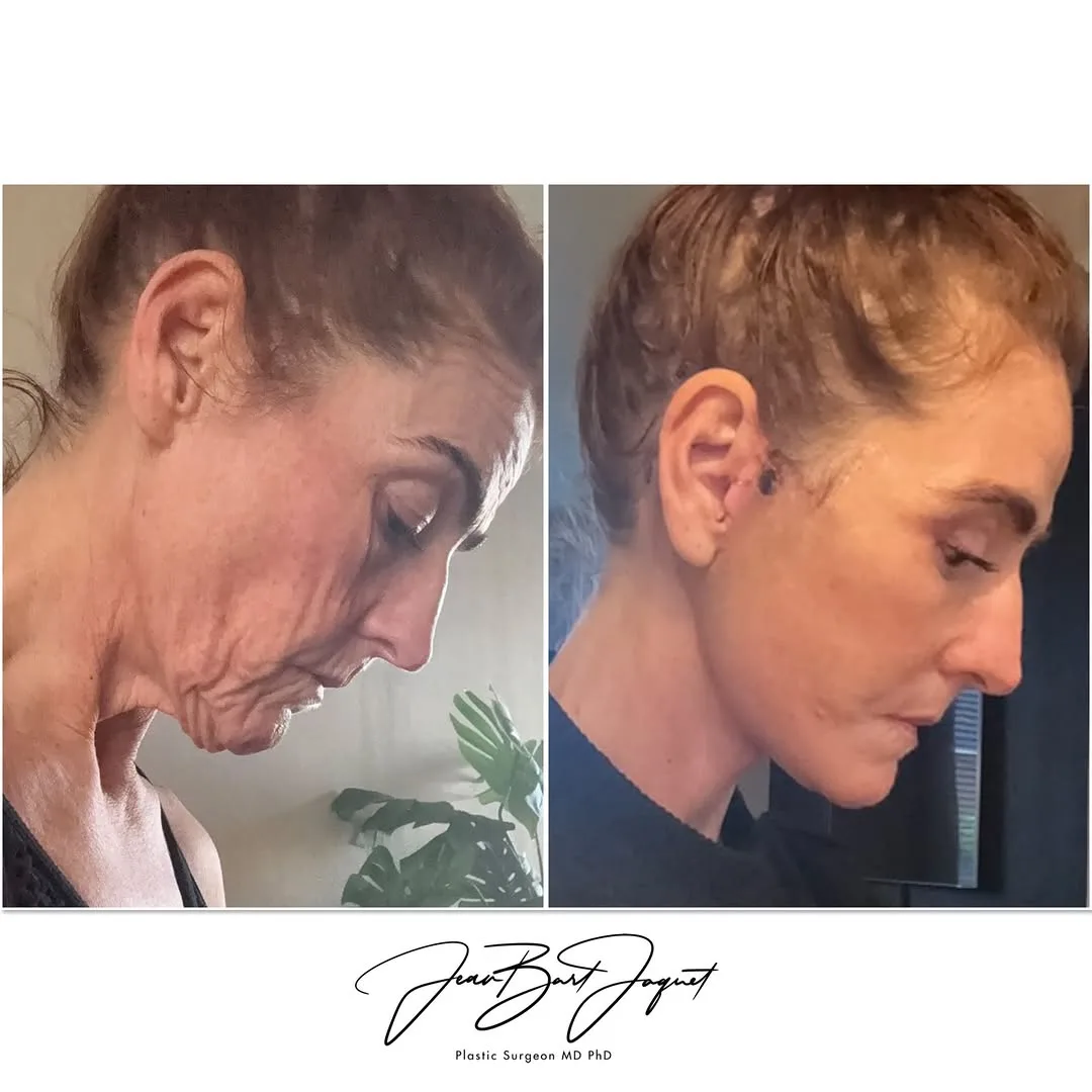 Before and after — Dr. Jean-Bart Jaquet