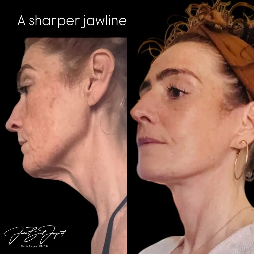 Before and after — Dr. Jean-Bart Jaquet