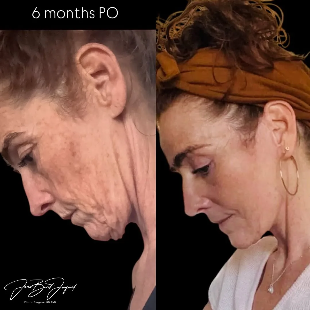 Before and after — Dr. Jean-Bart Jaquet