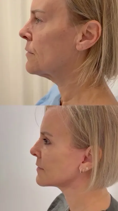 Before and after deep plane facelift — -1-year-old patient, frontal view by Dr. Jeff Lisiecki