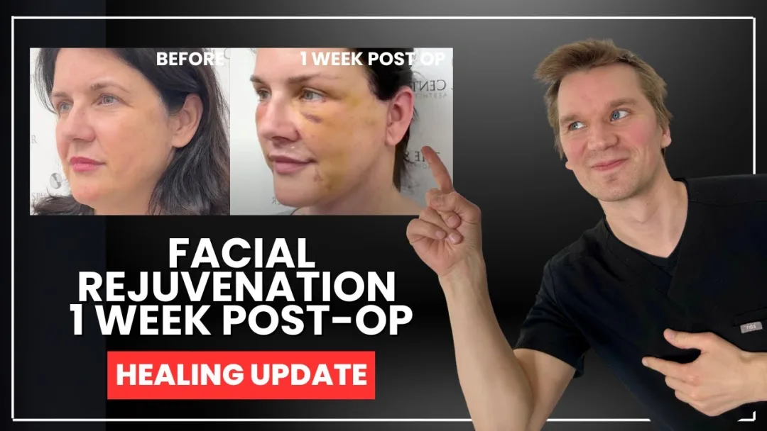 Before and after deep plane facelift — 45-year-old woman, three-quarter view, 1mo post-op by Dr. Jeffrey Spiegel