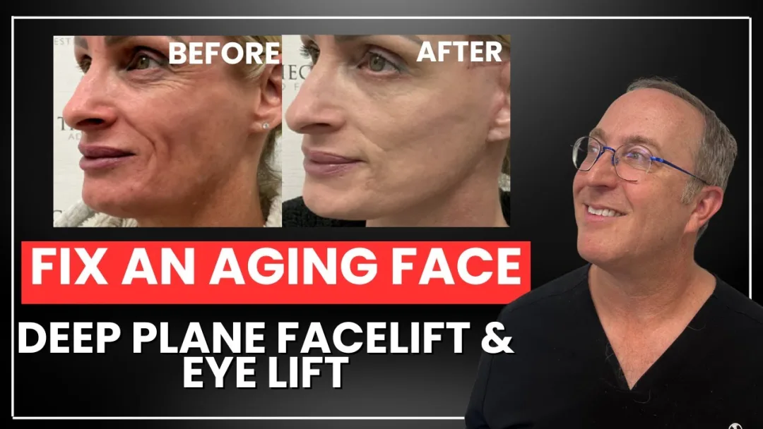 Before and after deep plane facelift — 58-year-old woman, left profile view, 9mo post-op by Dr. Jeffrey Spiegel