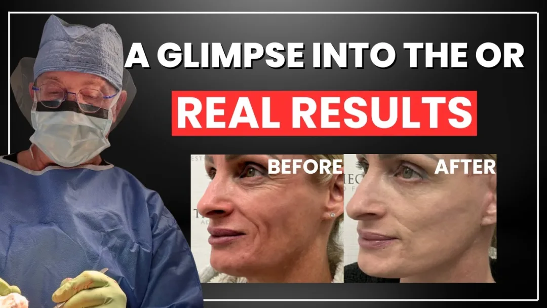 Before and after deep plane facelift — 55-year-old woman, oblique right view, 6mo post-op by Dr. Jeffrey Spiegel