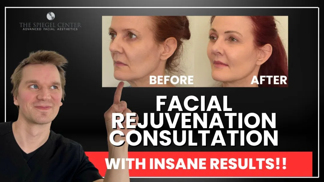 Before and after deep plane facelift — 45-year-old man, oblique left view, 6mo post-op by Dr. Jeffrey Spiegel
