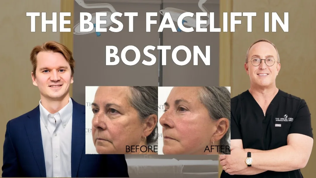 Before and after deep plane facelift — 55-year-old woman, left profile view, 6mo post-op by Dr. Jeffrey Spiegel